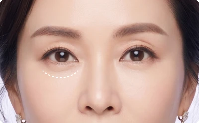 중안면거상술 후