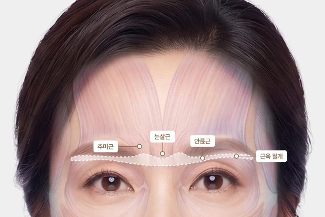 상안검만으로 부족할 수 있는 이유